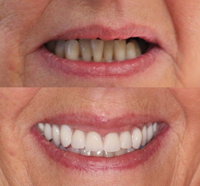 Upper Dentures Before And After Pictures Austin TX 78768